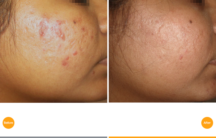 treatment yorkshire skin Scars SkinQure  Acne