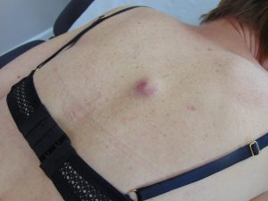 Cysts removed at Skinqure Welton
