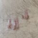 keloid scar